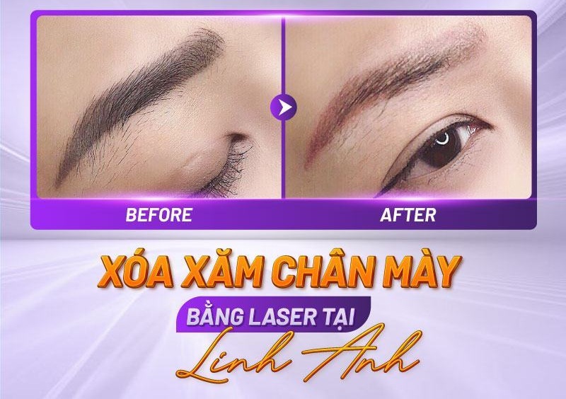 hình ảnh khi xóa xăm chân mày hình ảnh khi xóa xăm chân mày