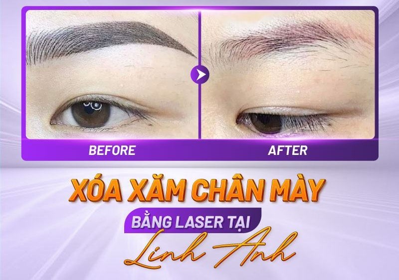 hình ảnh sau khi xóa xăm chân mày hình ảnh sau khi xóa xăm chân mày