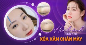 hình ảnh sau khi xóa xăm lông mày