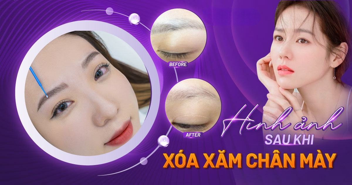 hình ảnh sau khi xóa xăm lông mày