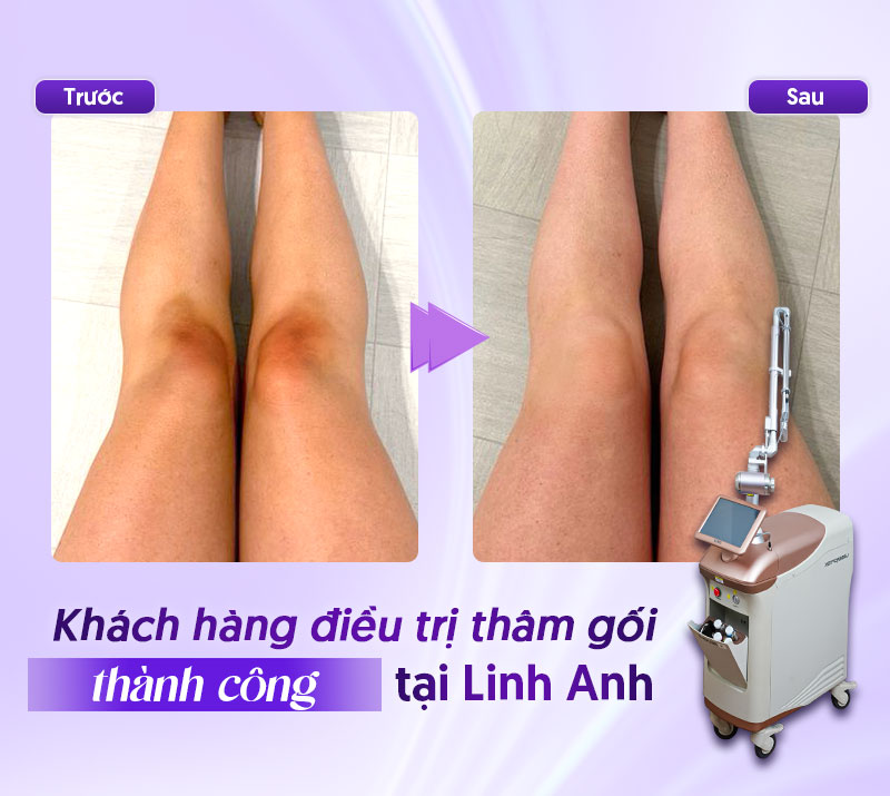 liệu trình trị thâm gối tại spa bao nhiêu liệu trình trị thâm gối tại spa bao nhiêu