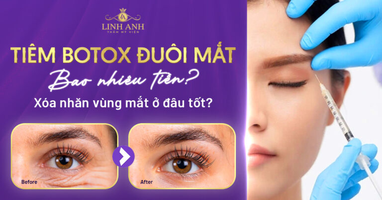 Tiêm botox đuôi mắt bao nhiêu tiền? Bảng chi phí mới nhất