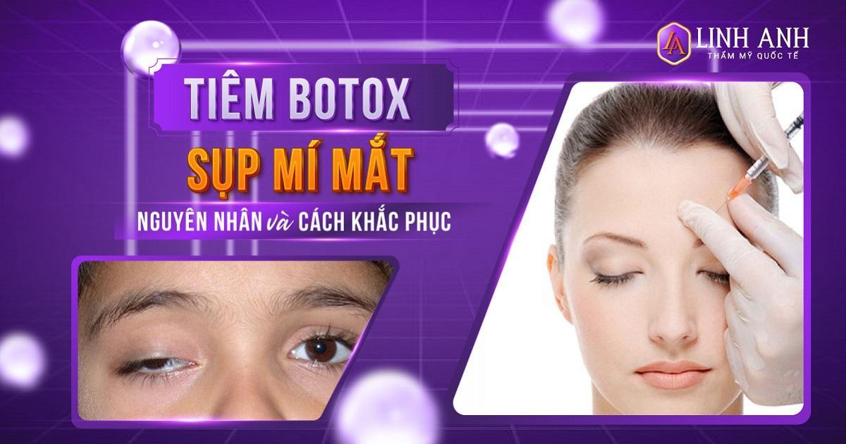 Tiêm Botox sụp mí mắt nguyên nhân do đâu? Cách khắc phục hiệu quả