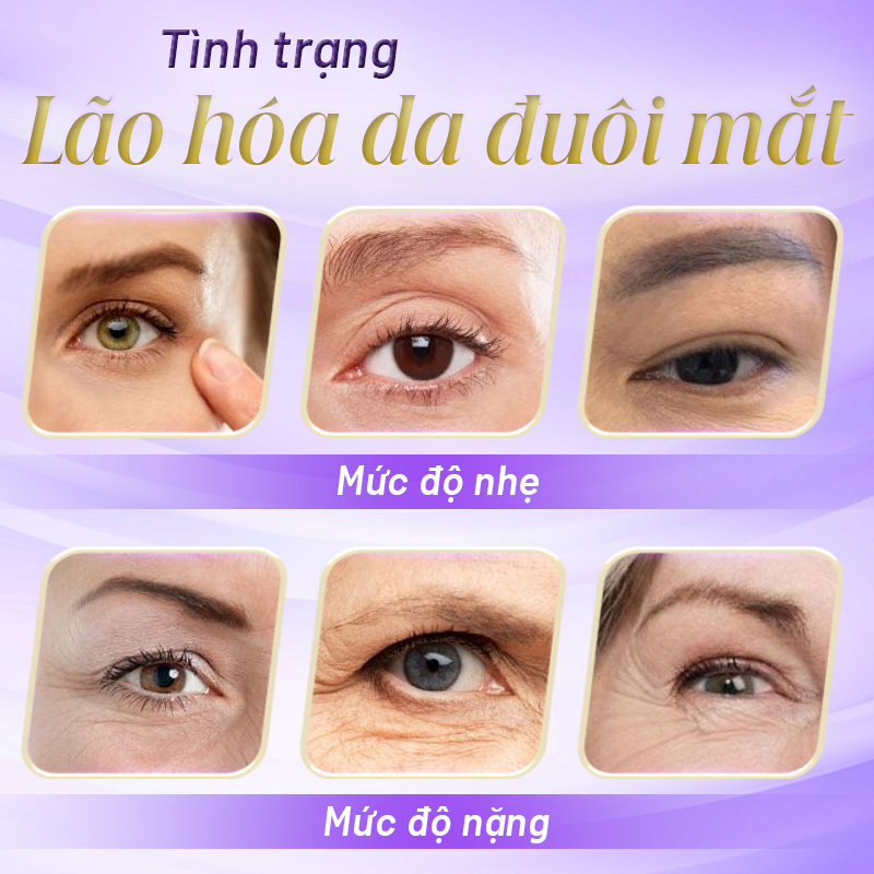 tiêm xóa nhăn mắt giá bao nhiêu