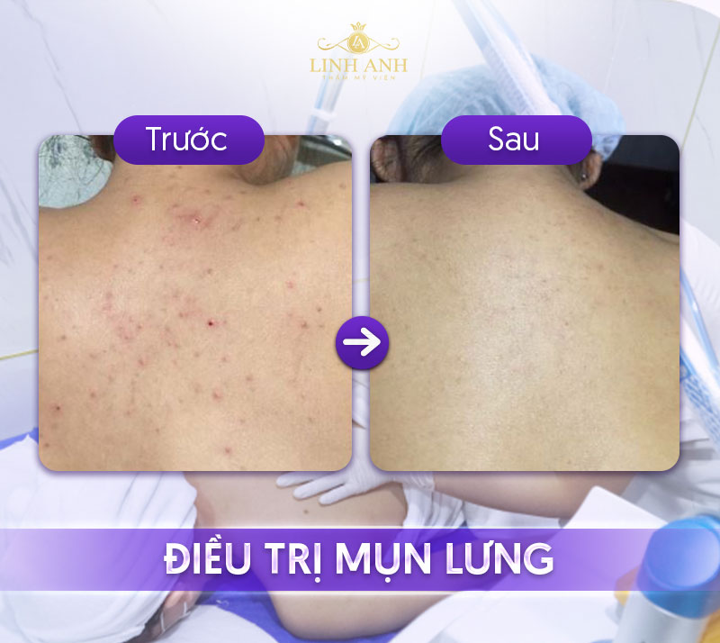 trị mụn lưng spa trị mụn lưng spa