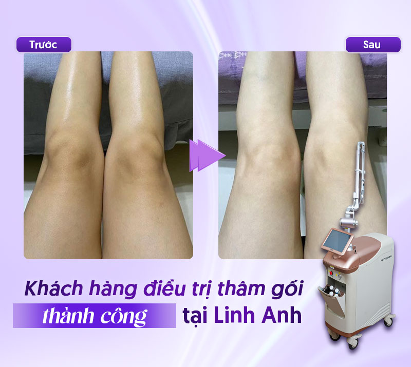 trị thâm gối tại spa giá mới nhất trị thâm gối tại spa giá mới nhất