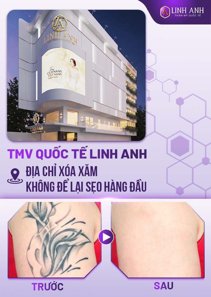 Top 5 địa chỉ xóa hình xăm uy tín nhất tại Hà Nội
