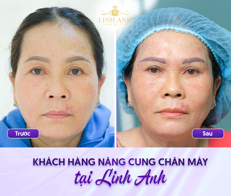 nâng cung chân mày bao nhiêu tiền nâng cung chân mày bao nhiêu tiền