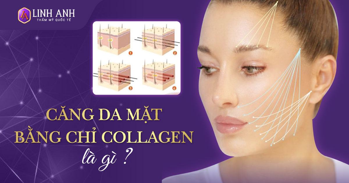 căng da mặt bằng chỉ collagen
