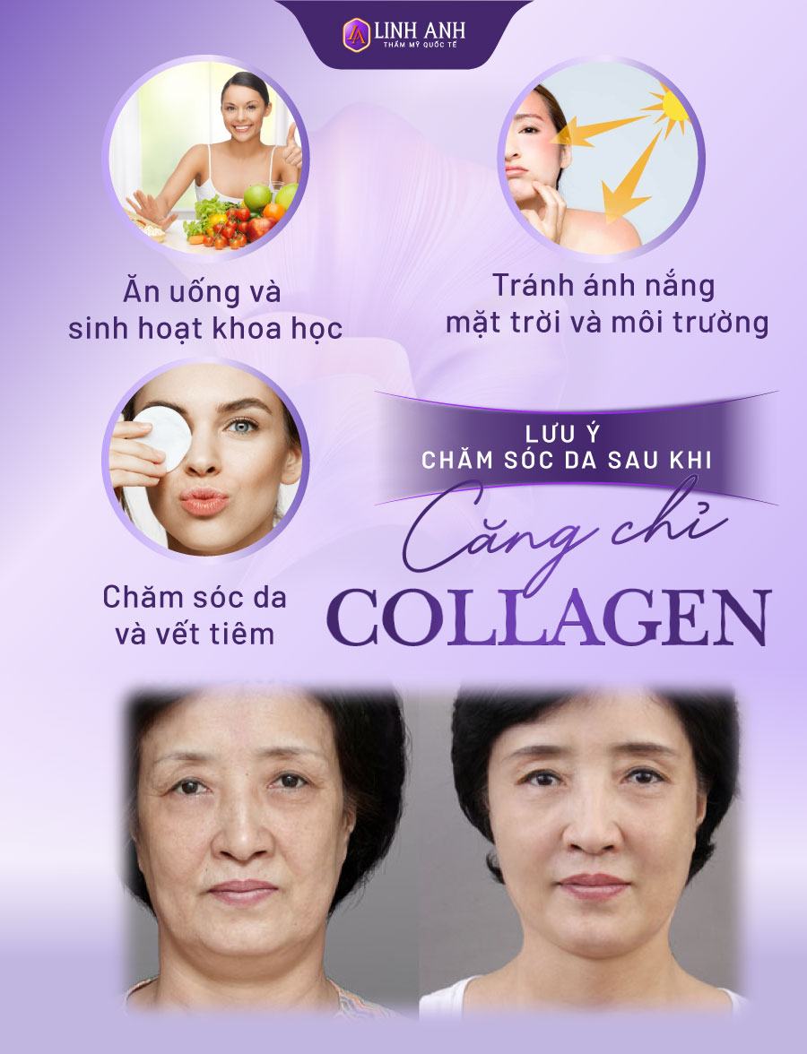 cấy chỉ Collagen giữ được bao lâu