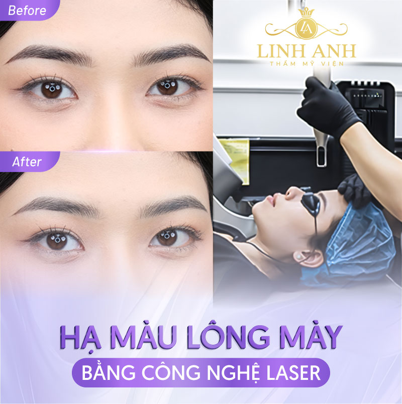 hạ màu lông mày bằng laser