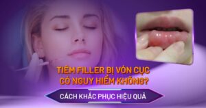 tiêm filler bị vón cục