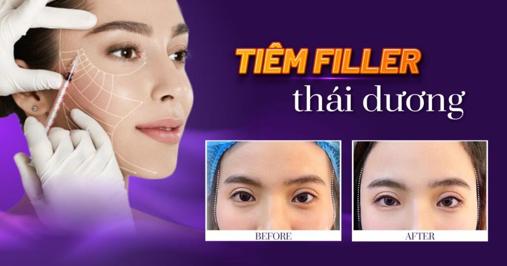 tiêm filler thái dương