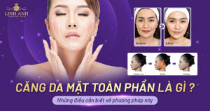 căng da mặt toàn phần