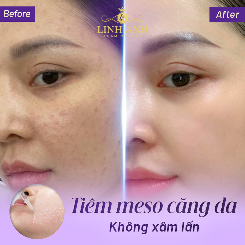 căng da mặt toàn phần là gì