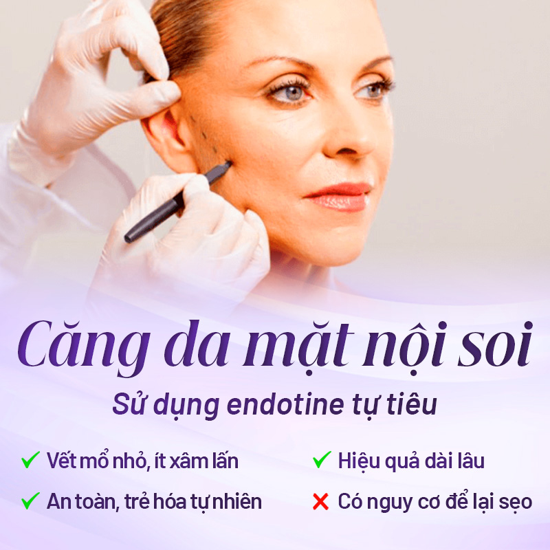 căng da mặt toàn phần tại Linh Anh
