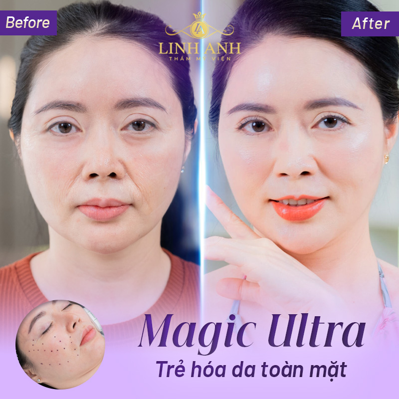 căng da mặt toàn phần uy tín