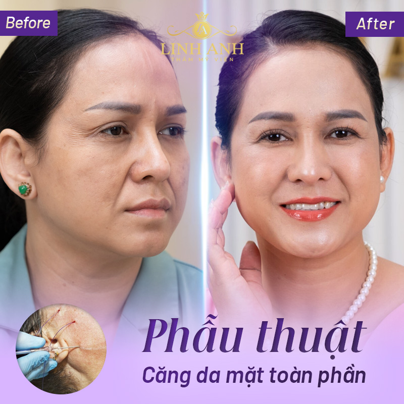 căng toàn phần da mặt