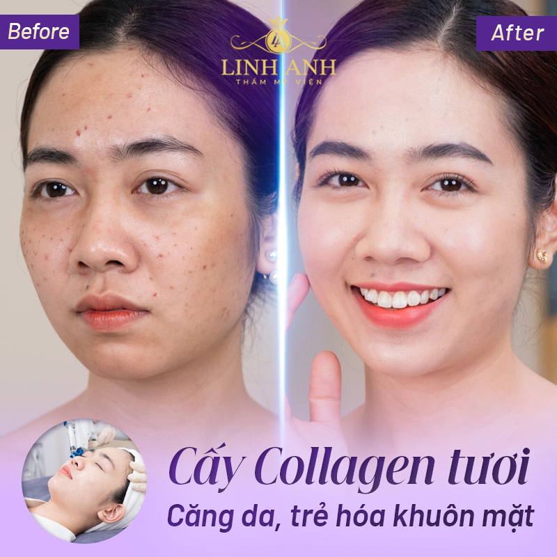 công nghệ căng da mặt toàn phần