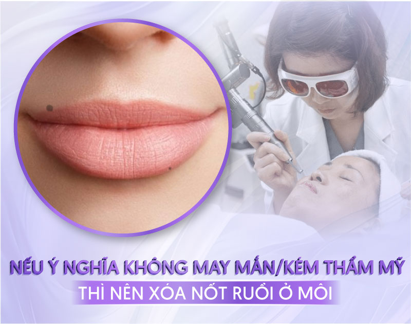 nốt ruồi ở viền môi trên