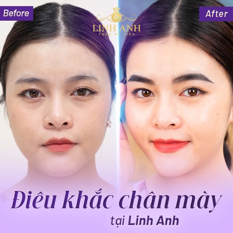 cấy lông mày tự thân có tốt không