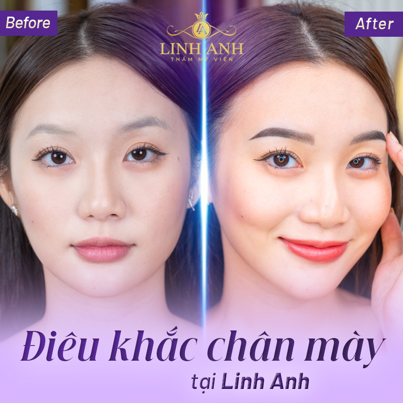 cấy mày tự thân là gì