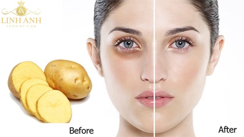 cách làm hết thâm quầng mắt sau 1 đêm với khoai tây
