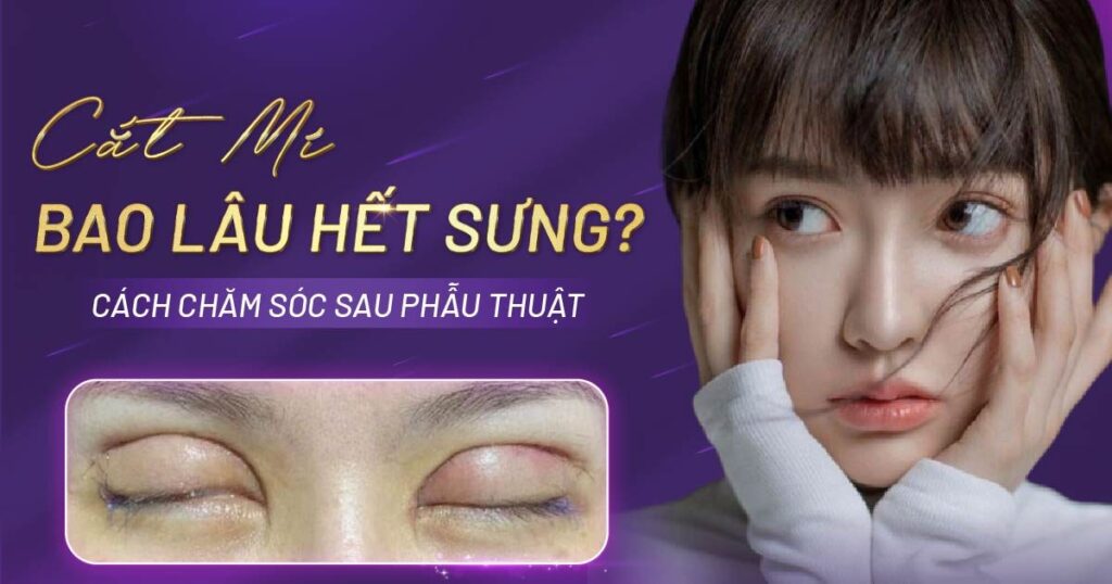 cắt mí bao lâu hết sưng