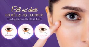 cắt mí dưới có để lại sẹo không