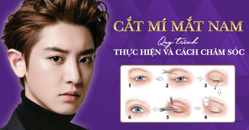 cắt mí mắt nam