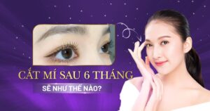 cắt mí sau 6 tháng