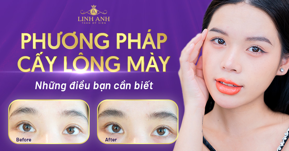 cấy lông mày