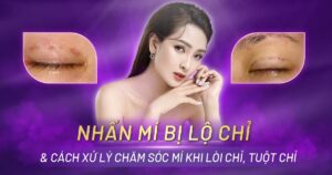 nhấn mí bị lộ chỉ