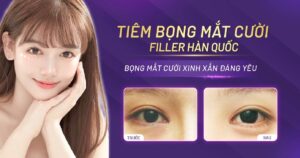 tiêm bọng mắt cười