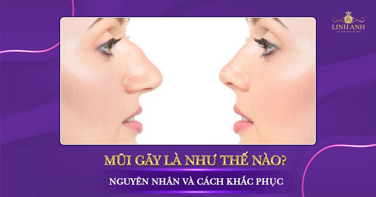 Gãy xương mũi và cách điều trị mũi gãy hiệu quả nhất