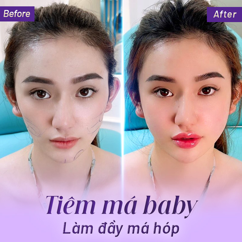 tiêm má baby vĩnh viễn bao nhiêu tiền