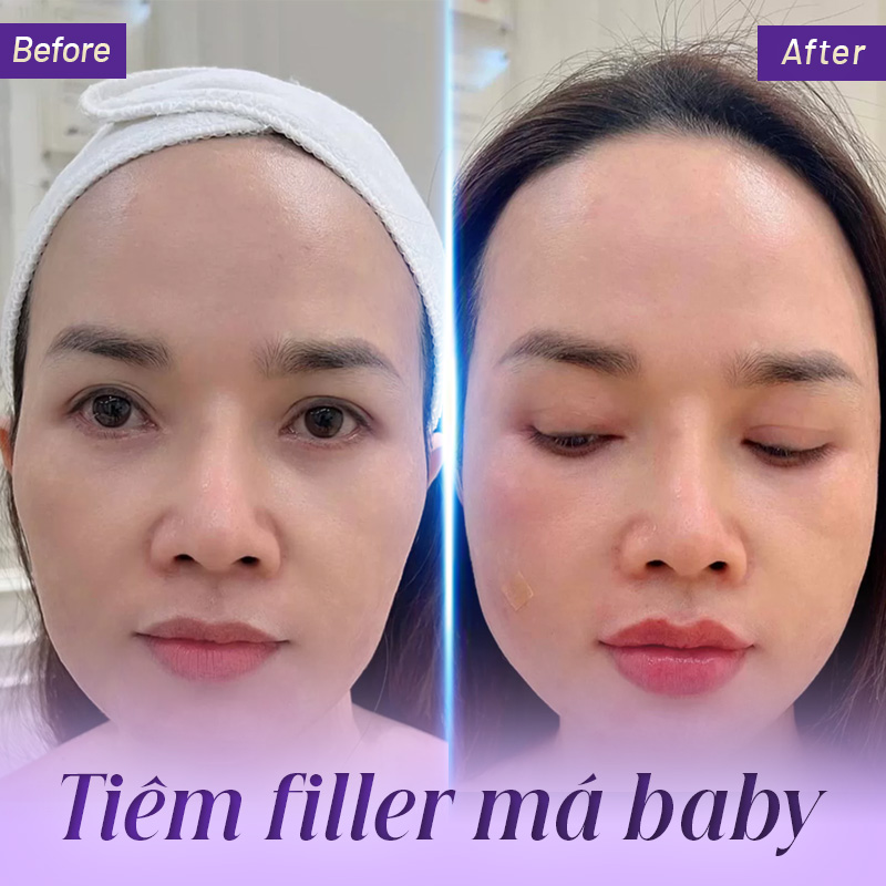 bảng giá tiêm filler má baby