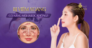 bị viêm xoang có nâng mũi được không