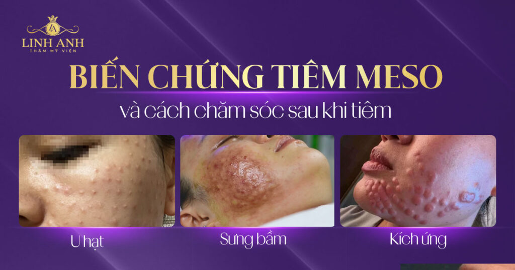 biến chứng tiêm meso