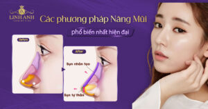 các phương pháp nâng mũi