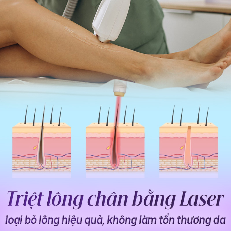 cách triệt lông chân vĩnh viễn