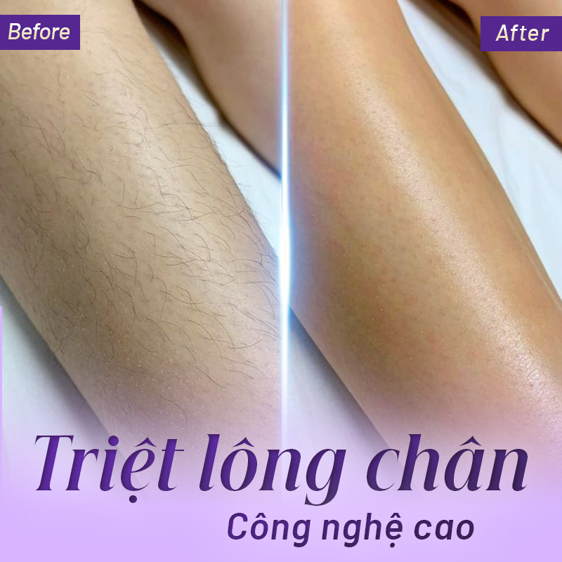 cách triệt lông chân