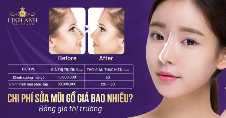 Chi phí sửa mũi gồ giá bao nhiêu? Bảng giá sửa mũi gồ mới nhất