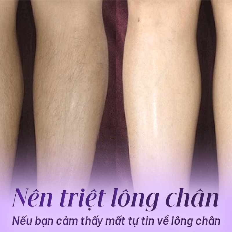 có nên tẩy lông chân