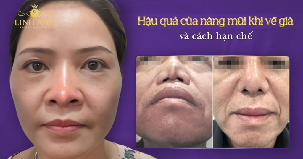 hậu quả của nâng mũi khi về già