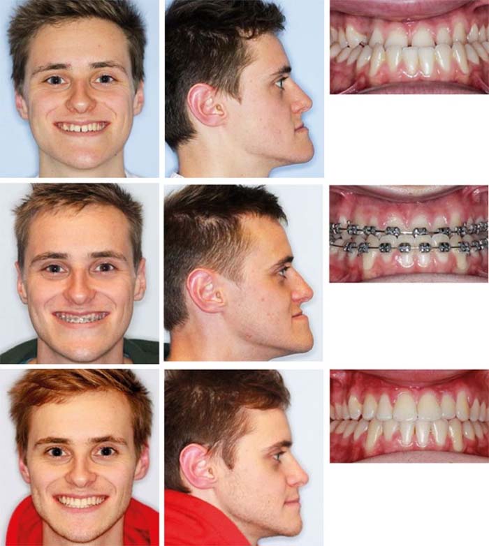 Niềng răng cải thiện cằm nhô ra phía trước