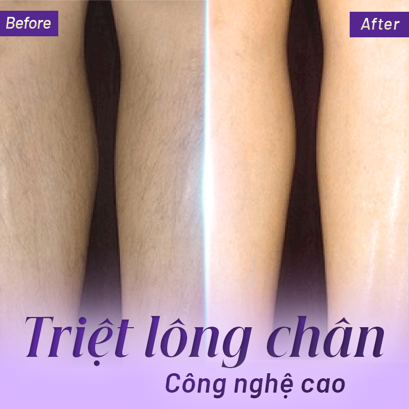 triệt lông chân hiệu quả