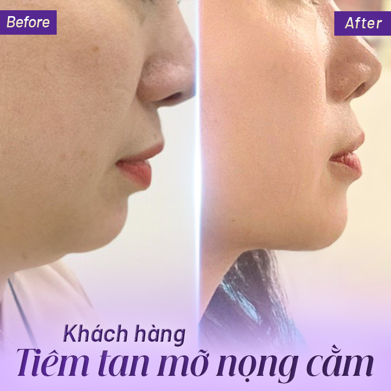 chi phí tiêm tan mỡ nọng cằm