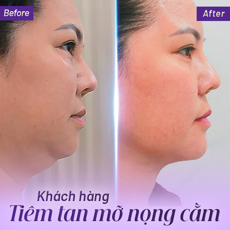 tiêm giảm mỡ nọng cằm bao nhiêu