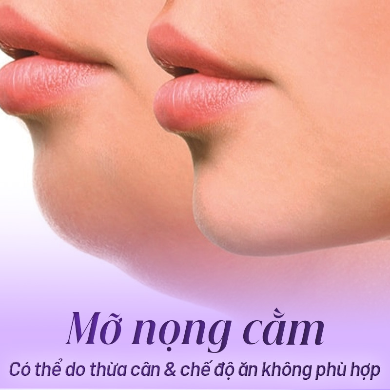 tiêm nọng cằm giá bao nhiêu